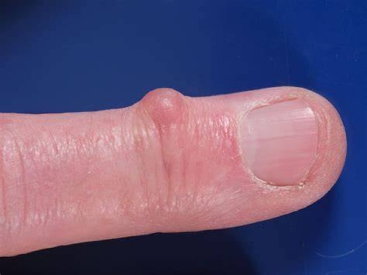 Are mucous cysts hard?