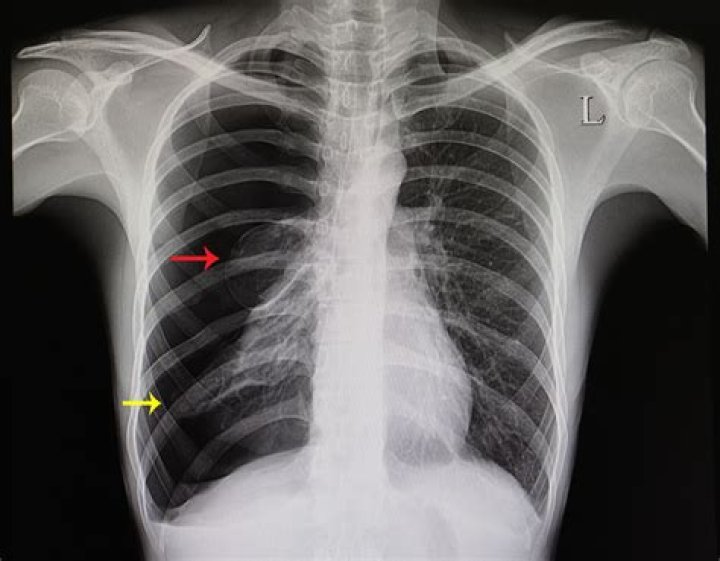 Can a lung be collapsed?