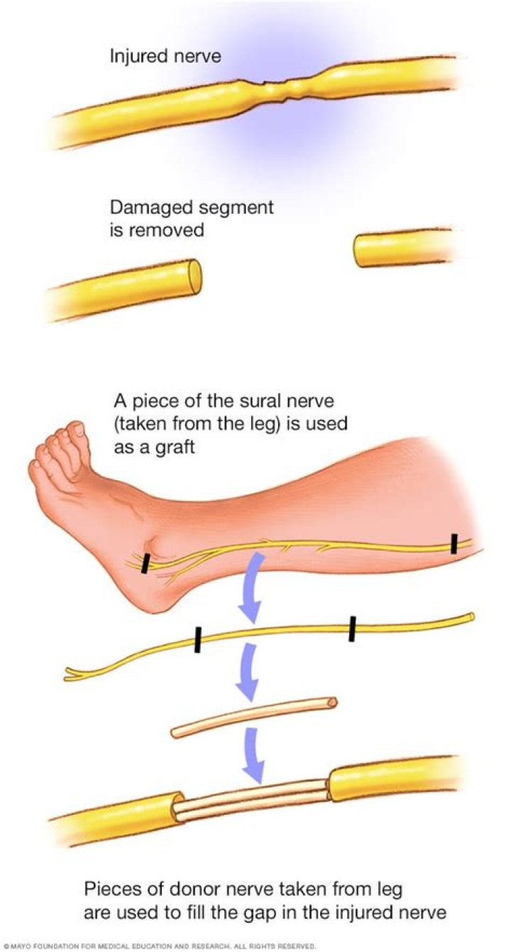 Can a nerve damage be repaired?