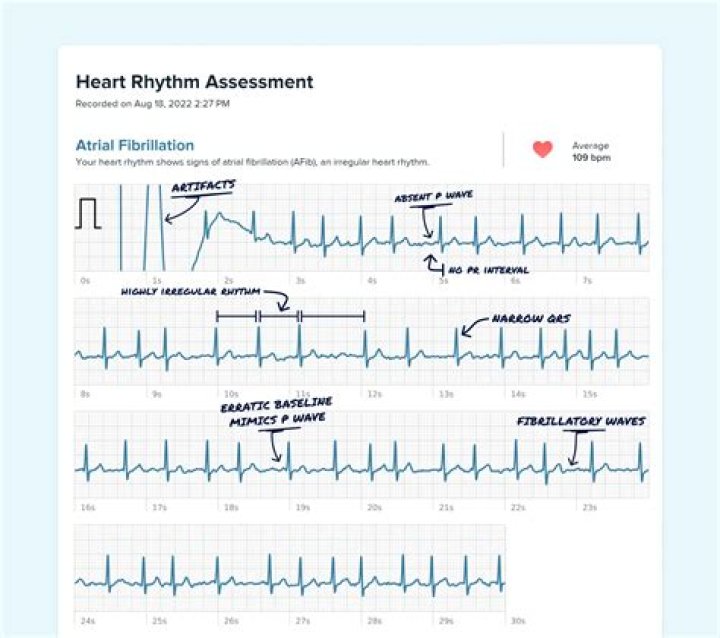 Can afib last seconds?