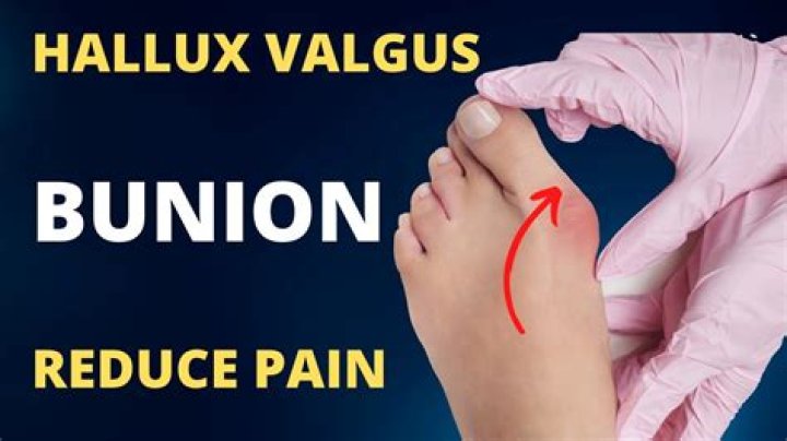 Can you fix hallux valgus?