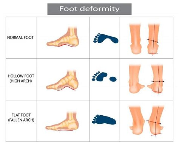 Can you have one flat foot?
