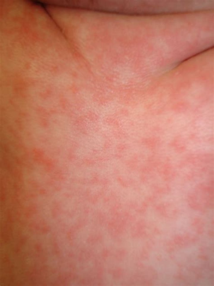 Can you have roseola twice?