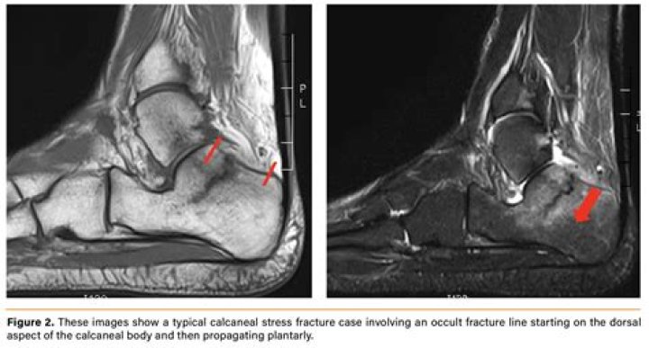 Can you walk on a calcaneal stress fracture?
