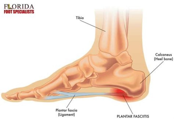 Could plantar fasciitis cause knee pain?
