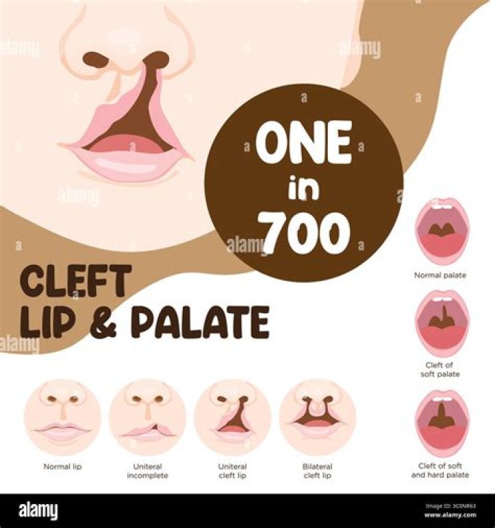 Do babies with cleft palate get teeth?