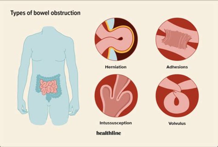 Do bowel obstruction symptoms come and go?