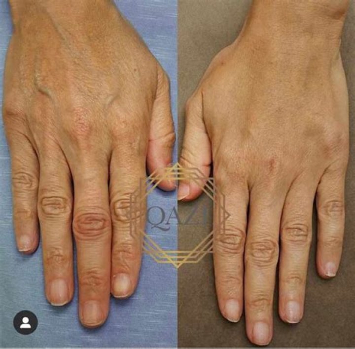 Do hand fillers work?