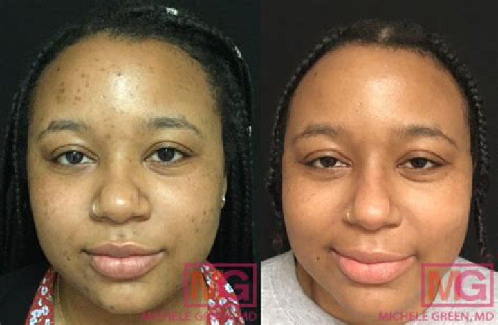 Do tanning beds help acne?