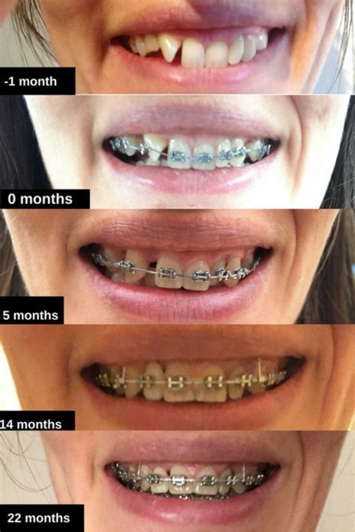 Do they numb you for braces?