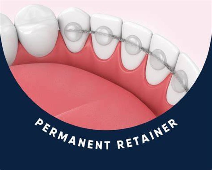 Do you need retainers after braces?