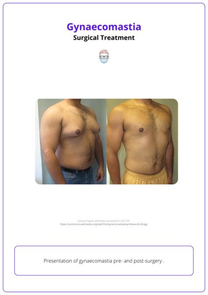 Does gynecomastia go away after stopping propecia?