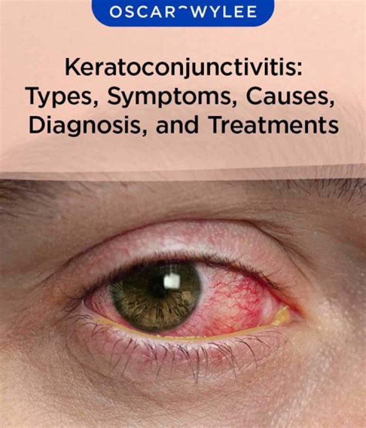 For the treatment of keratoconjunctivitis the patient may be prescribed with?