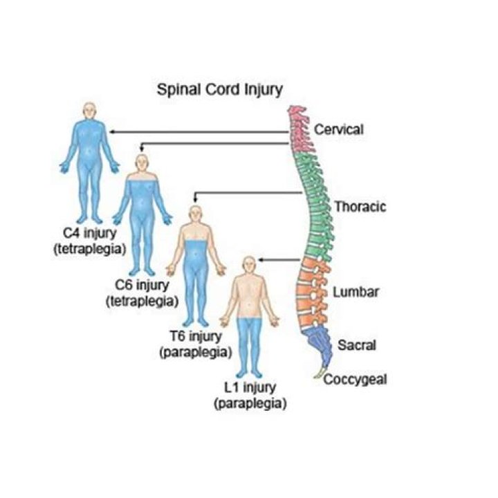 How does paraplegia change over time?