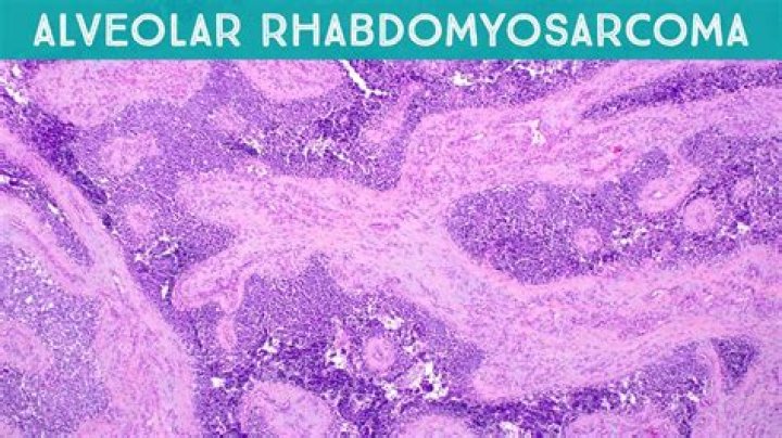 Is alveolar rhabdomyosarcoma hereditary?