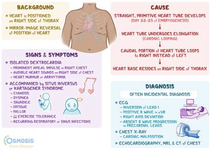 Is dextrocardia a genetic disorder?
