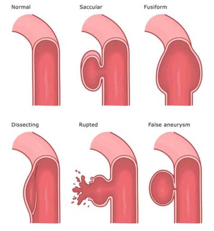 Should an unruptured aneurysm be treated?