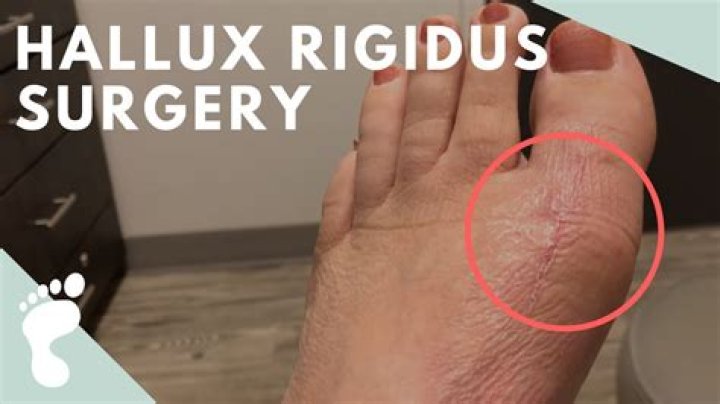 Should i have hallux rigidus surgery?