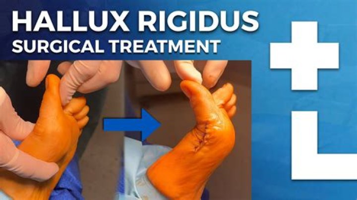 Should i have surgery for hallux rigidus?