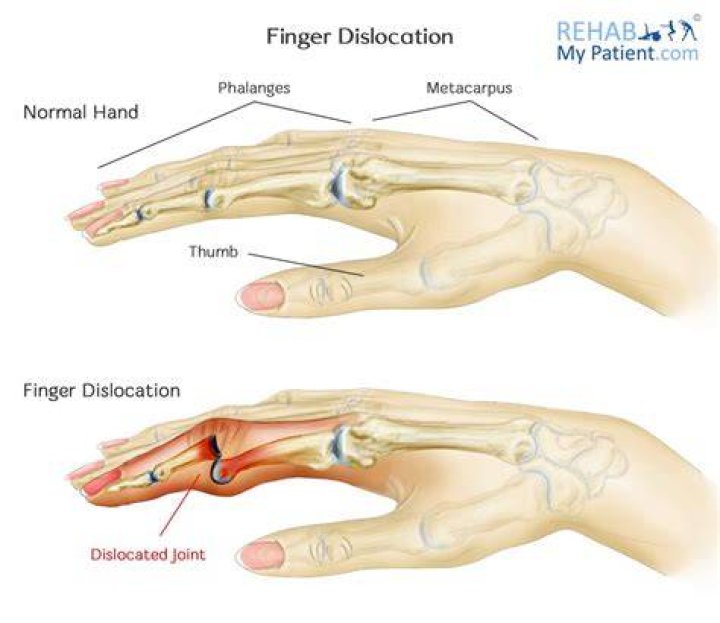 Should you splint a dislocated finger?