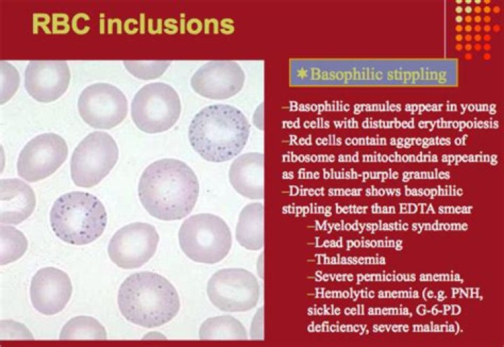 What causes basophilic stippling?