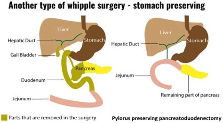 What does pancreatoduodenectomy mean?
