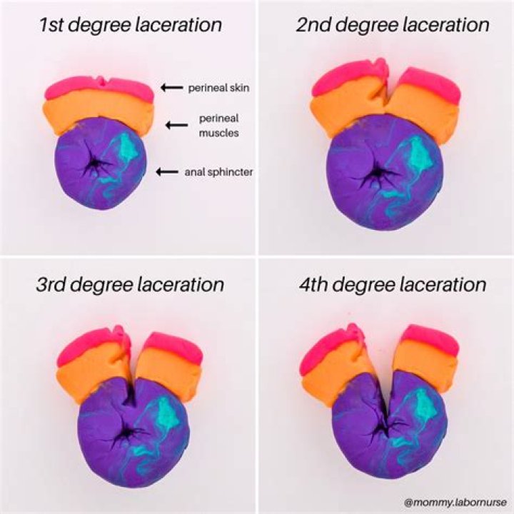 What is 3rd degree cut during labor?
