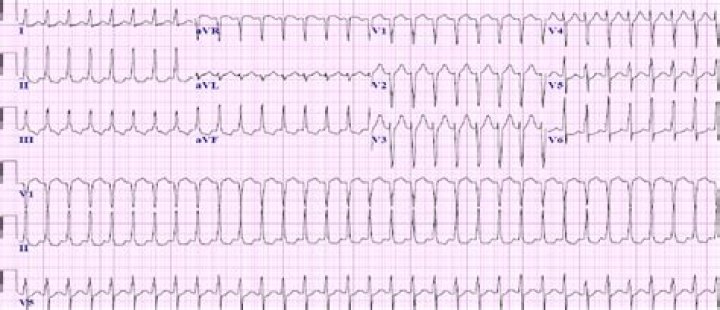 What is orthodromic reciprocating tachycardia?