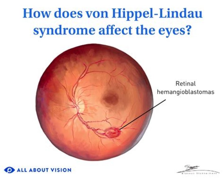 What is von hippel lindau?