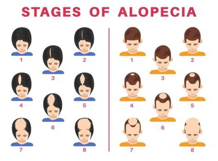 When does alopecia go away?