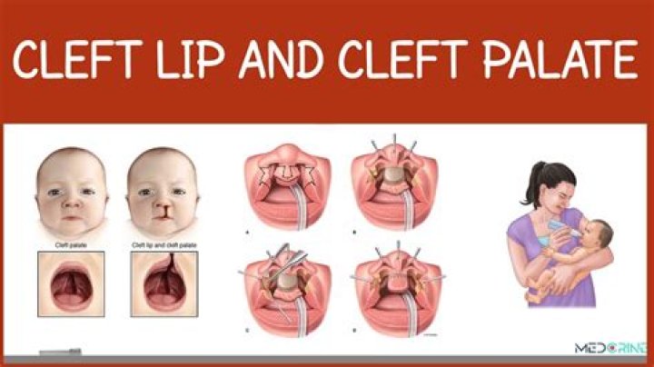 When is cleft lip diagnosed?