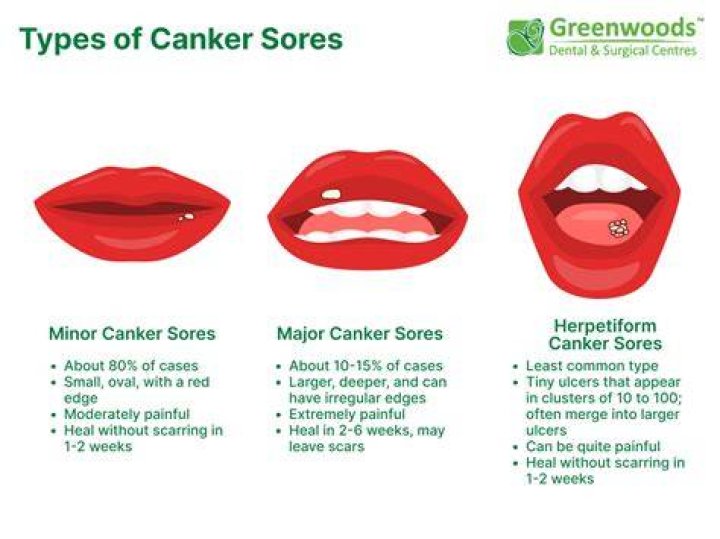 Where does canker sores look like?