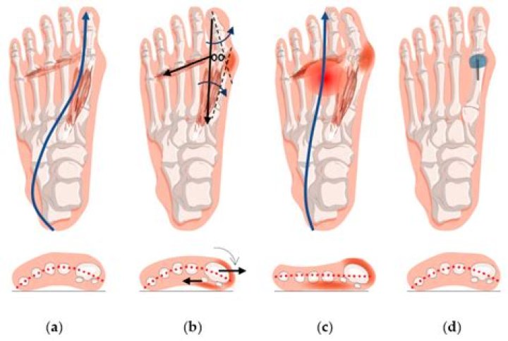 Where is my forefoot?