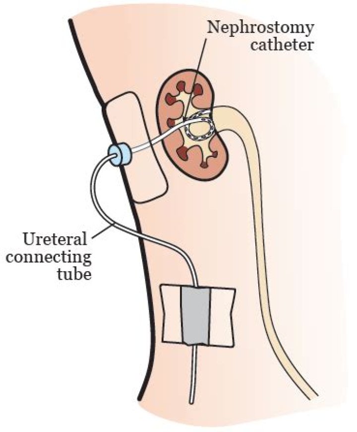 Where is nephrostomy tube placed?
