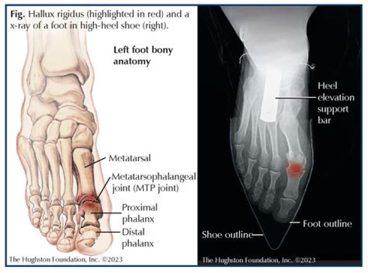 Which toe is the hallux?