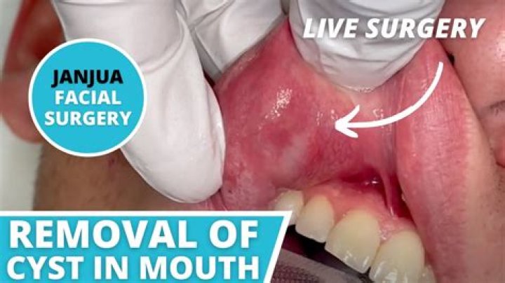 Who can remove mucous cyst?