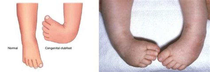 Who is more at risk for clubfoot?