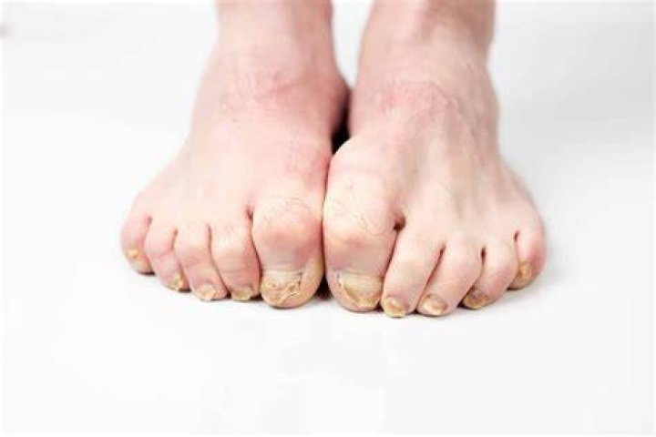 Why are my toenails curving down?