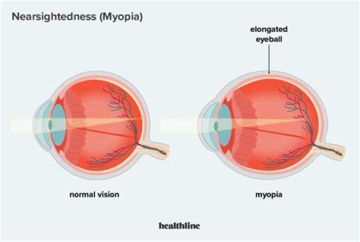 Why does nearsightedness get worse?