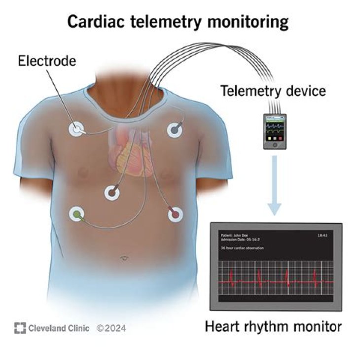 Will a heart monitor pick up palpitations?