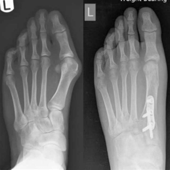 Will dislocated toe heal itself?