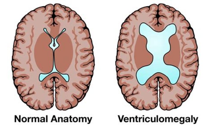 Will mri show hydrocephalus?